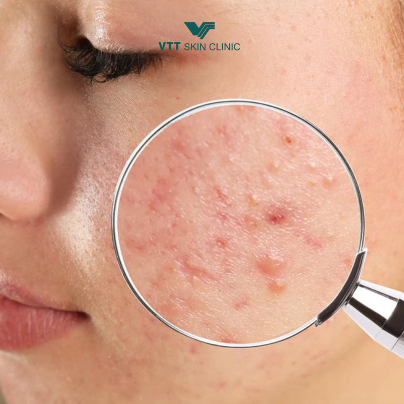 Các loại sẹo mụn thường gặp
