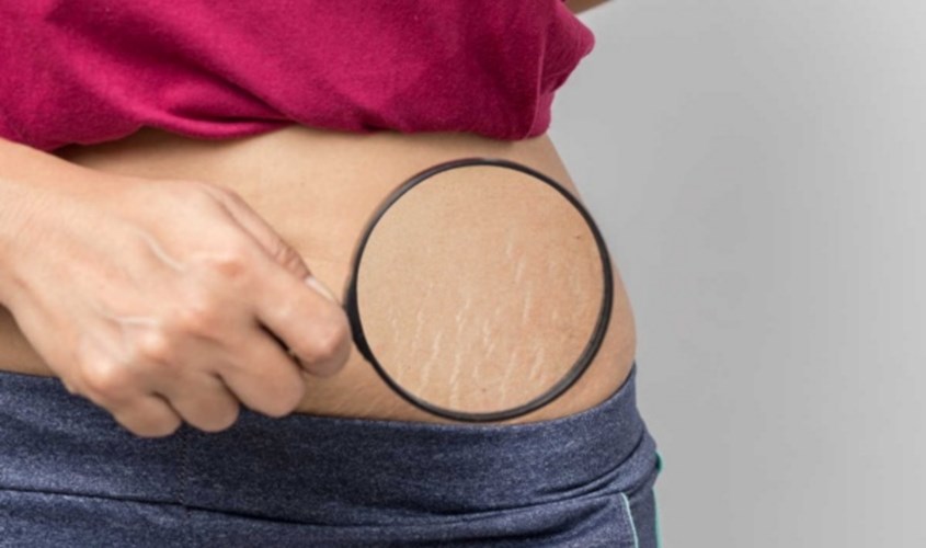 Các giai đoạn rạn da và ảnh hưởng đến hiệu quả điều trị