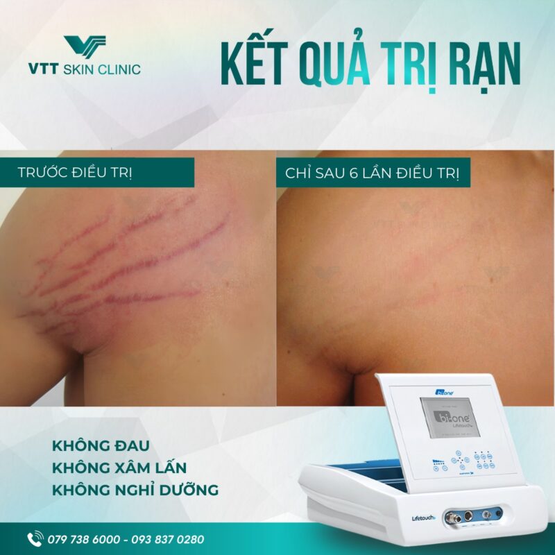 Công nghệ Biodermogenesi® (Bi-One) - xu hướng điều trị rạn mới