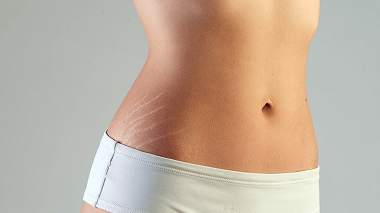 Tại sao gầy mà vẫn bị rạn da?