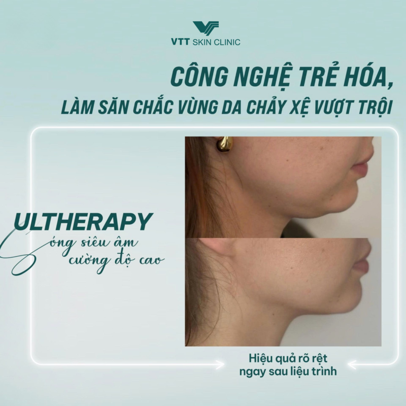 Tác dụng của Ultherapy là gì?