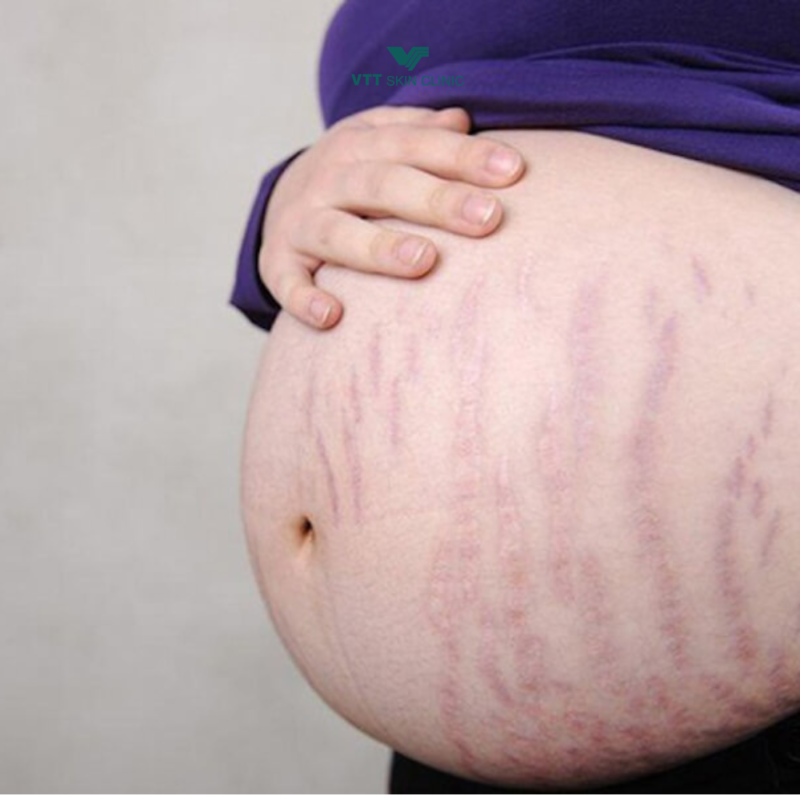 Bị rạn da có chữa được không?