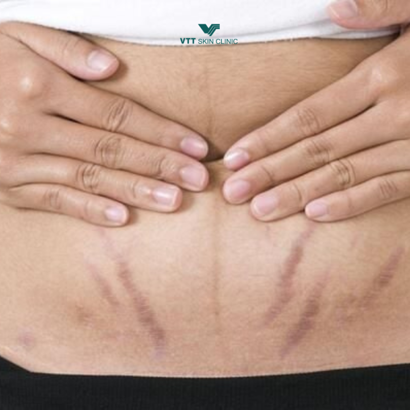 Phân biệt rạn đỏ và rạn trắng