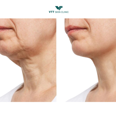 Ultherapy và Thermage khác nhau như thế nào?