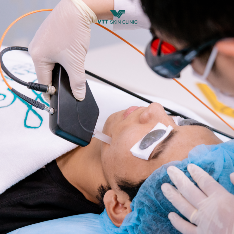 Laser hơi đồng 