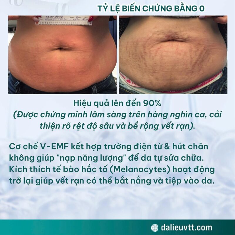 Công nghệ Bi-one điều trị rạn da với hiệu quả đến 60 - 85%